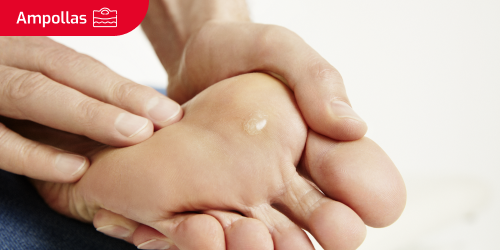 Miniatura de ¿Cómo tratar una ampolla en la piel?  Miniatura de ¿Cómo tratar una ampolla en la piel?